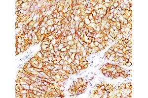 Formalin-paraffin human renal cell carcinoma stained with CAIX antibody (66. (CA9 anticorps)