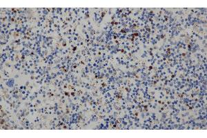 Immunohistochemistry of paraffin-embedded Human cervical cancer tissue using CD68 Polyclonal Antibody at dilution 1:30 (CD68 anticorps)