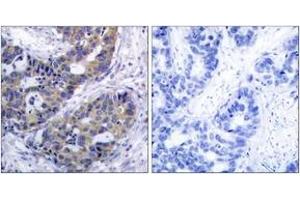 Immunohistochemistry analysis of paraffin-embedded human breast carcinoma tissue, using IRS-1 (Ab-312) Antibody. (IRS1 anticorps  (AA 279-328))