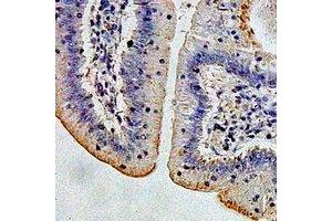 Immunohistochemical analysis of AMY2A staining in human colon cancer formalin fixed paraffin embedded tissue section. (AMY2A anticorps)