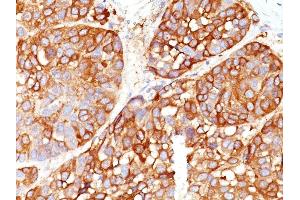 Formalin-fixed, paraffin-embedded human Melanoma stained with Melanoma Marker Mouse Monoclonal (DT101+ BC199 + T311 + HMB45). (Melanoma Marker (MART-1 + Tyrosinase + Gp100) anticorps)