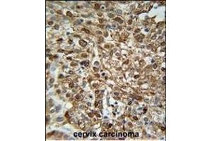 WDR43 Antibody (C-term) (ABIN651679 and ABIN2840356) immunohistochemistry analysis in formalin fixed and paraffin embedded human Cervix carcinoma followed by peroxidase conjugation of the secondary antibody and DAB staining. (WDR43 anticorps  (C-Term))
