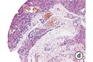 Immunhistochemistry image of OPN staining in paraffin sections of synovial tissue of pigmented villonodular synovitis (PVNS) patients. (Osteopontin anticorps  (AA 164-179))