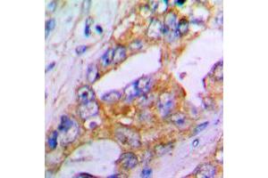 Immunohistochemical analysis of Aggrecan staining in human lung cancer formalin fixed paraffin embedded tissue section. (Aggrecan anticorps  (N-Term))