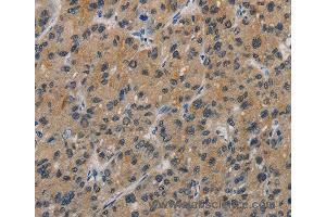 Immunohistochemistry of Human liver cancer using CASP9 Polyclonal Antibody at dilution of 1:60 (Caspase 9 anticorps)