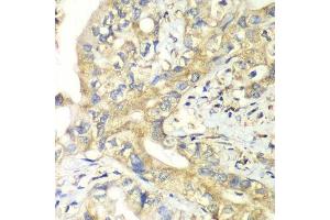 Immunohistochemistry of paraffin-embedded human liver cancer using TIMM17A antibody. (TIMM17A anticorps  (AA 1-171))