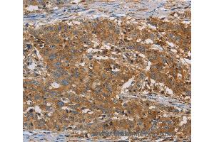 Immunohistochemistry of Human gastic cancer using CFL1 Polyclonal Antibody at dilution of 1:30 (Cofilin anticorps)