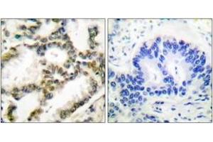 Immunohistochemistry analysis of paraffin-embedded human lung carcinoma tissue, using DJ-1 Antibody. (PARK7/DJ1 anticorps  (AA 21-70))
