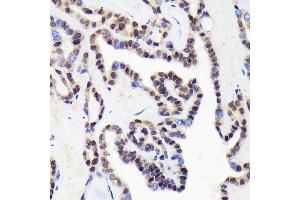 Immunohistochemistry of paraffin-embedded human thyroid cancer using CDC Rabbit mAb (ABIN1682192, ABIN3018455, ABIN3018456 and ABIN7101613) at dilution of 1:100 (40x lens). (CDCA5 anticorps)