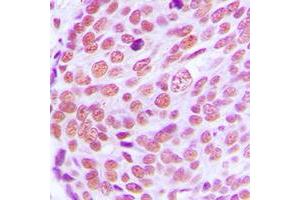 Immunohistochemical analysis of Lamin A/C staining in human breast cancer formalin fixed paraffin embedded tissue section. (Lamin A/C anticorps  (Center))