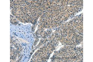 Immunohistochemistry of Human liver cancer using CRLF2 Polyclonal Antibody at dilution of 1:60 (CRLF2 anticorps)