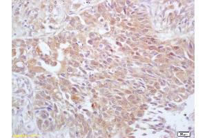 Formalin-fixed and paraffin embedded human lung carcinoma labeled with Anti-Phospho-cdc25A (Thr506) Polyclonal Antibody, Unconjugated (ABIN684028) at 1:200 followed by conjugation to the secondary antibody and DAB staining (CDC25A anticorps  (pThr507))