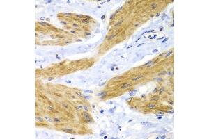 Immunohistochemistry of paraffin-embedded human gastric cancer using HRAS antibody. (HRAS anticorps)