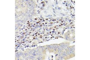 Immunohistochemistry of paraffin-embedded human colon carcinoma using MEF2A+MEF2C Rabbit mAb (ABIN1679049, ABIN1679050, ABIN7101495 and ABIN7101496) at dilution of 1:100 (40x lens). (MEF2A+MEF2C anticorps)