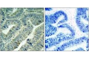 Immunohistochemistry analysis of paraffin-embedded human colon carcinoma, using Src (Phospho-Tyr418) Antibody. (Src anticorps  (pTyr419))
