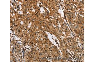 Immunohistochemistry of Human gastic cancer using PTK6 Polyclonal Antibody at dilution of 1:40 (PTK6 anticorps)