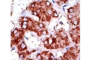 IHC analysis of FFPE human hepatocarcinoma tissue stained with the CPT1B antibody (CPT1B anticorps  (AA 606-637))