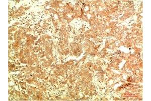 Immunohistochemical analysis of paraffin-embedded Human Breast Carcinoma Tissue using ATG5 Mouse mAb diluted at 1:2000 (ATG5 anticorps)