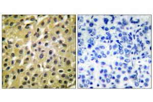 Immunohistochemical analysis of paraffin-embedded human breast carcinoma tissue, using MDM2 antibody (ABIN5976454). (MDM2 anticorps  (C-Term))