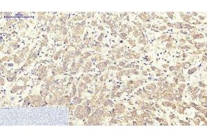 Immunohistochemistry of paraffin-embedded Human breast cancer tissue using ITGA2B Monoclonal Antibody at dilution of 1:200. (Integrin Alpha2b anticorps)