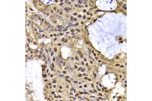 Immunohistochemistry of paraffin-embedded human oophoroma using ARID3A antibody. (ARID3A anticorps)