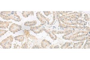 Immunohistochemistry of paraffin-embedded Human thyroid cancer tissue using EPRS Polyclonal Antibody at dilution of 1:60(x200) (EPRS anticorps)