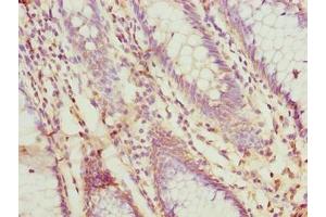Immunohistochemistry of paraffin-embedded human colon cancer using ABIN7156187 at dilution of 1:100 (PRSS35 anticorps  (AA 201-413))