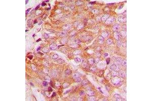 Immunohistochemical analysis of YTHDF1 staining in human breast cancer formalin fixed paraffin embedded tissue section. (YTHDF1 anticorps  (N-Term))