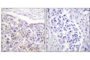 Immunohistochemical analysis of paraffin-embedded human breast carcinoma tissue using p90 RSK (Phospho-Thr573) antibody (left)or the same antibody preincubated with blocking peptide (right). (RPS6KA1 anticorps  (pThr573))