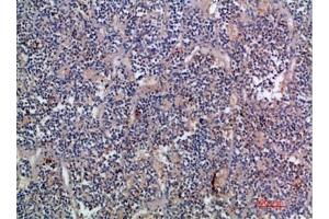 Immunohistochemical analysis of paraffin-embedded human-kidney-cancer, antibody was diluted at 1:200. (EGF anticorps  (AA 1000-1060))