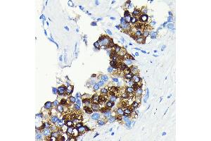 Immunohistochemistry of paraffin-embedded human liver cancer using C-Reactive Protein (C-Reactive Protein (CRP)) Rabbit mAb (ABIN7265972) at dilution of 1:100 (40x lens). (CRP anticorps)