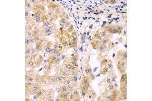 Immunohistochemistry of paraffin-embedded human liver cancer using SULT2B1 antibody at dilution of 1:100 (x40 lens). (SULT2B1 anticorps)