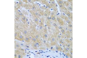 Immunohistochemistry of paraffin-embedded human liver cancer using FURIN antibody at dilution of 1:100 (40x lens). (FURIN anticorps)