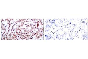Immunohistochemical analysis of paraffin-embedded human breast carcinoma tissue using ATF-2 (phospho-Thr73 or 55) antibody (E011032). (ATF2 anticorps  (pThr55, pThr73))