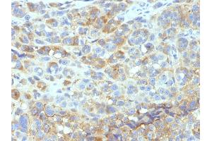 Formalin-fixed, paraffin-embedded human Melanoma stained with CD54 Monoclonal Antibody (W-CAM-1). (ICAM1 anticorps)