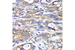 Immunohistochemistry of paraffin-embedded human gastric cancer using H antibody (ABIN6129787, ABIN6141601, ABIN6141603 and ABIN6216048) at dilution of 1:100 (40x lens). (HAPLN1 anticorps  (AA 165-354))