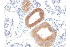 Formalin-fixed, paraffin-embedded human melanoma stained with CD86 antibody (C86/1146). (CD86 anticorps)