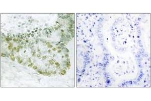 Immunohistochemistry analysis of paraffin-embedded human lung carcinoma tissue, using Hic-5 (Ab-60) Antibody. (TGFB1I1 anticorps  (AA 31-80))
