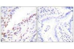 Immunohistochemistry analysis of paraffin-embedded human lung carcinoma tissue, using Ki67antibody. (Ki-67 anticorps  (C-Term))