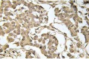 Immunohistochemistry (IHC) analyzes of p-eIF2alpha in paraffin-embedded human breast carcinoma tissue. (EIF2S1 anticorps  (pSer51))