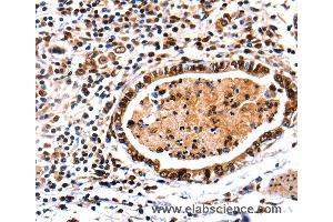 Immunohistochemistry of Human stomach cancer using DNMT3A Polyclonal Antibody at dilution of 1:65 (DNMT3A anticorps)