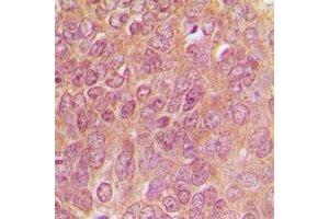 Immunohistochemical analysis of TPH1 staining in human breast cancer formalin fixed paraffin embedded tissue section. (Tryptophan Hydroxylase 1 anticorps)