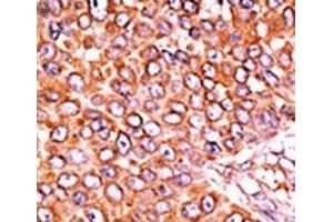 IHC analysis of FFPE human breast carcinoma tissue stained with the phospho-p27Kip1 antibody. (CDKN1B anticorps  (pThr157))