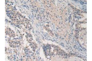 IHC-P analysis of Human Lung Cancer Tissue, with DAB staining. (MMP19 anticorps  (AA 98-508))