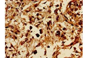 Immunohistochemistry of paraffin-embedded human melanoma using ABIN7154494 at dilution of 1:100 (PIK3R1 anticorps  (AA 15-180))