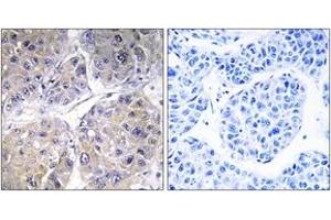 Immunohistochemistry analysis of paraffin-embedded human liver carcinoma tissue, using SLC27A5 Antibody. (SLC27A5 anticorps  (AA 481-530))