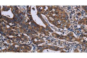 Immunohistochemistry of paraffin-embedded Human gastic cancer using LZTFL1 Polyclonal Antibody at dilution of 1:50 (LZTFL1 anticorps)