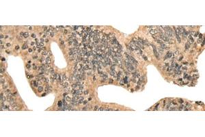 Immunohistochemistry of paraffin-embedded Human colorectal cancer tissue using CCNB1IP1 Polyclonal Antibody at dilution of 1:30(x200) (CCNB1IP1 anticorps)