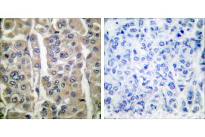 Peptide - +Immunohistochemical analysis of paraffin-embedded human breast carcinoma tissue using Involucrin antibody (#C0236). (Involucrin anticorps)