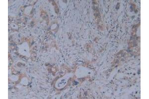 IHC-P analysis of Human Pancreas Cancer Tissue, with DAB staining. (Fibrillin 1 anticorps  (AA 246-389))